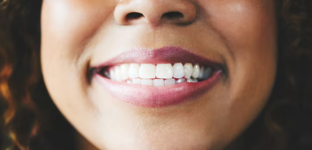 Restylane® smile lines treatment