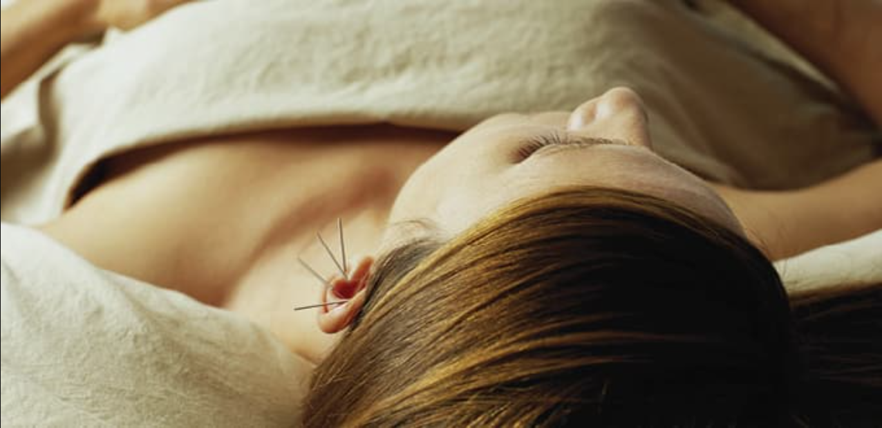 Traditional chinese acupuncture – 1 session